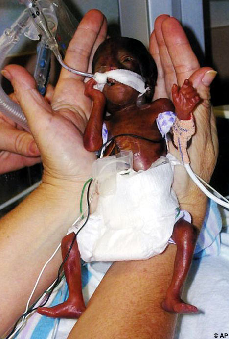 A Miracle Baby Amilla Born at just 22 weeks -